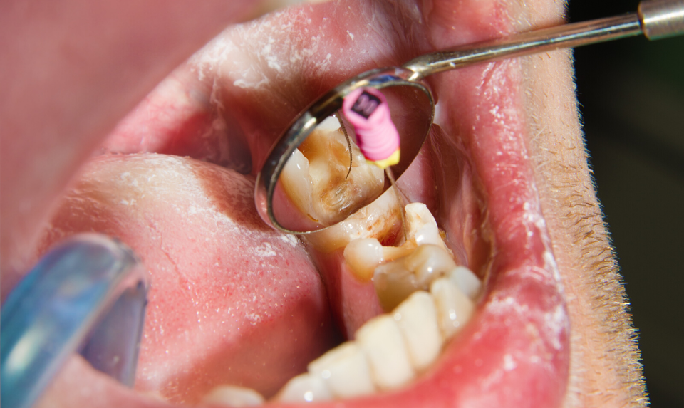 The infected tooth should first be cleaned during a root canal procedure.