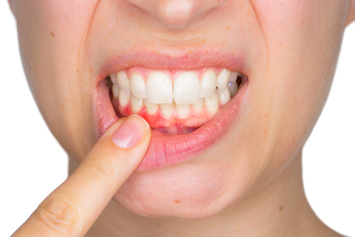 The best gum disease treatment is prevention - taking care of your oral health.